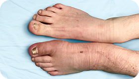 Диабетическая нейроостеоартропатия