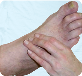 Заболевания артерий нижних конечностей при сахарном диабете